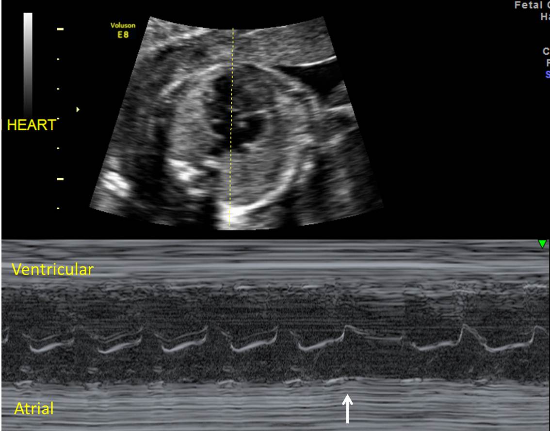 Fetal Tachycardia The Clinical Advisor