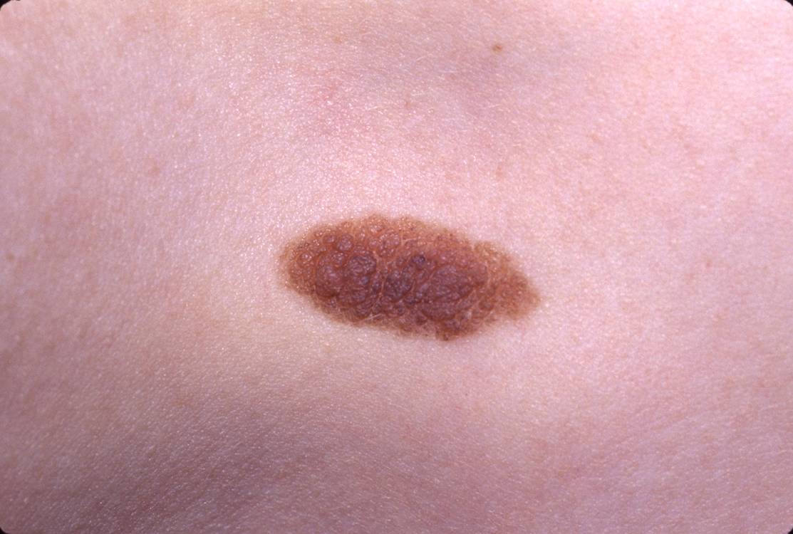 birthmarks-babycenter