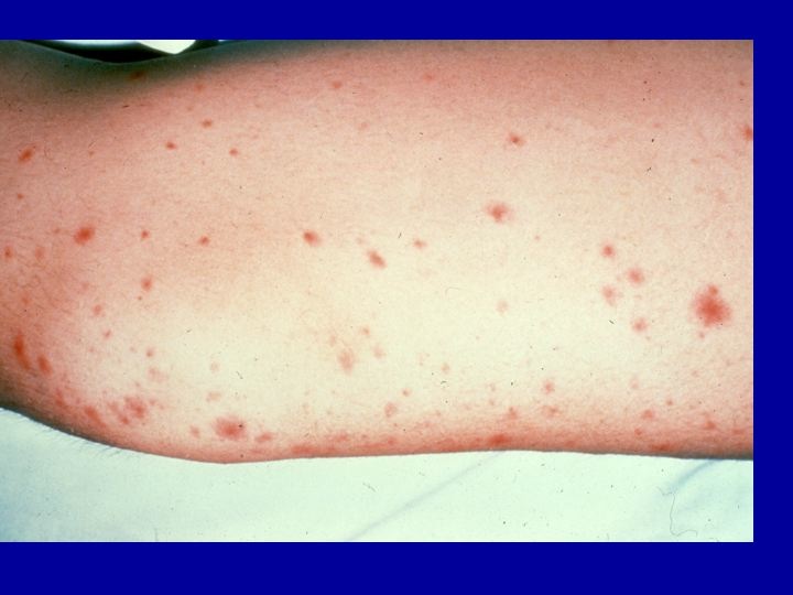 Fungal Infections Candidamolds Candidemia Invasive Candidiasis