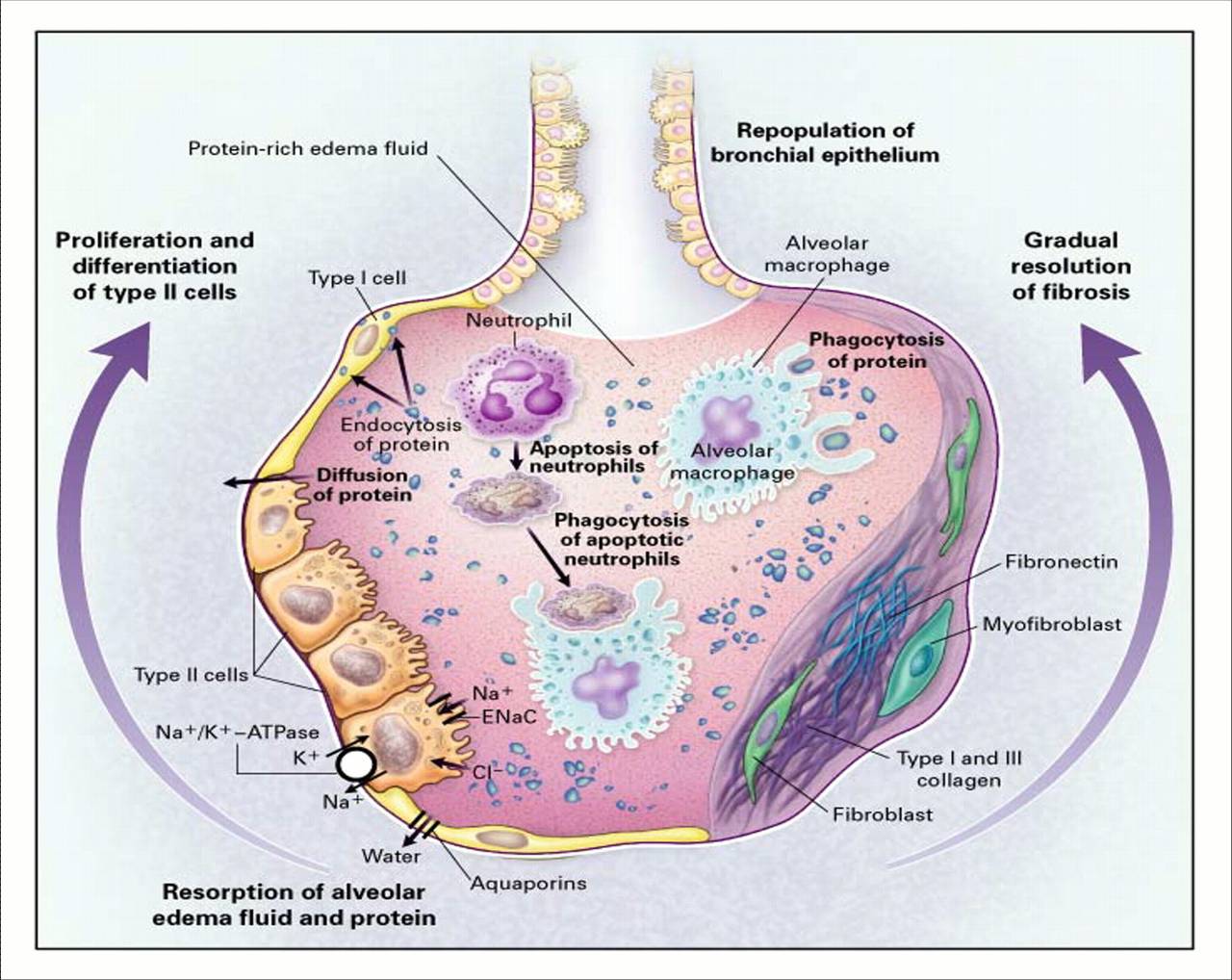 pathophysiology of acute hypoxemic respiratory failure
