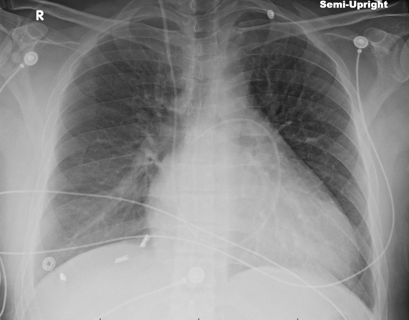 Causes of Heart Failure The Clinical Advisor