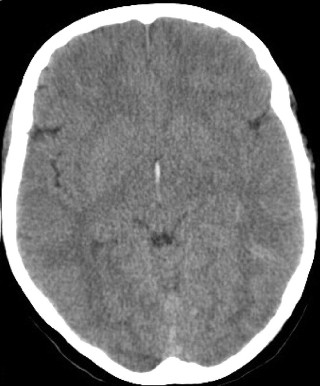 Cerebral Edema The Clinical Advisor