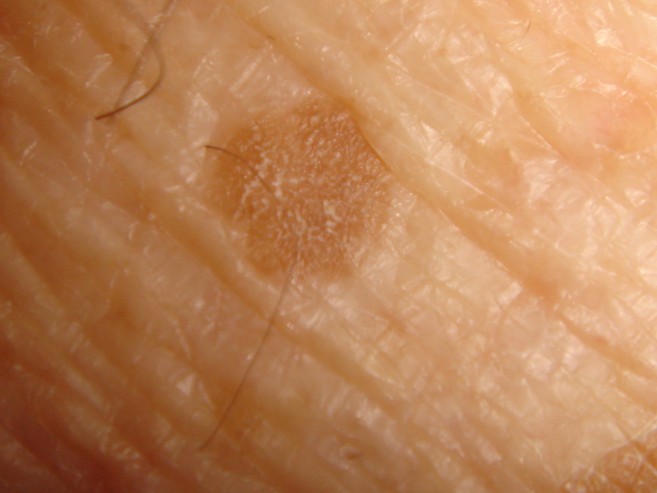 actinic-keratosis-solar-keratosis-sun-spots-the-clinical-advisor