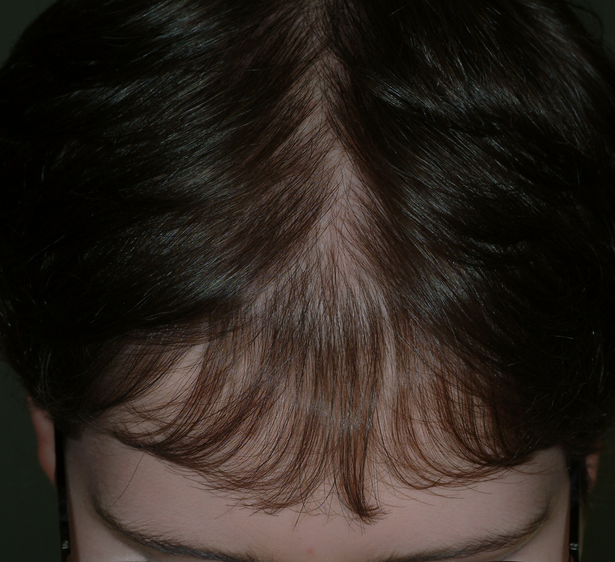 alopecia-androgenetic-the-clinical-advisor