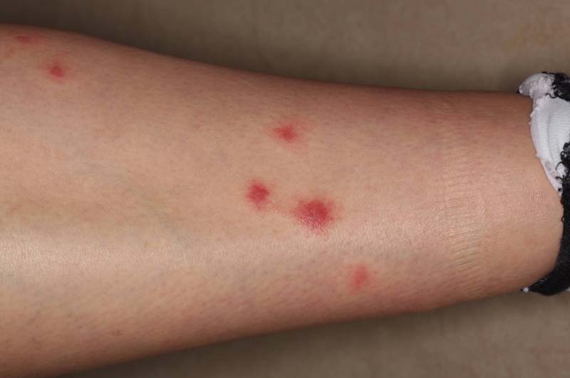 Common Insect Stings Uk