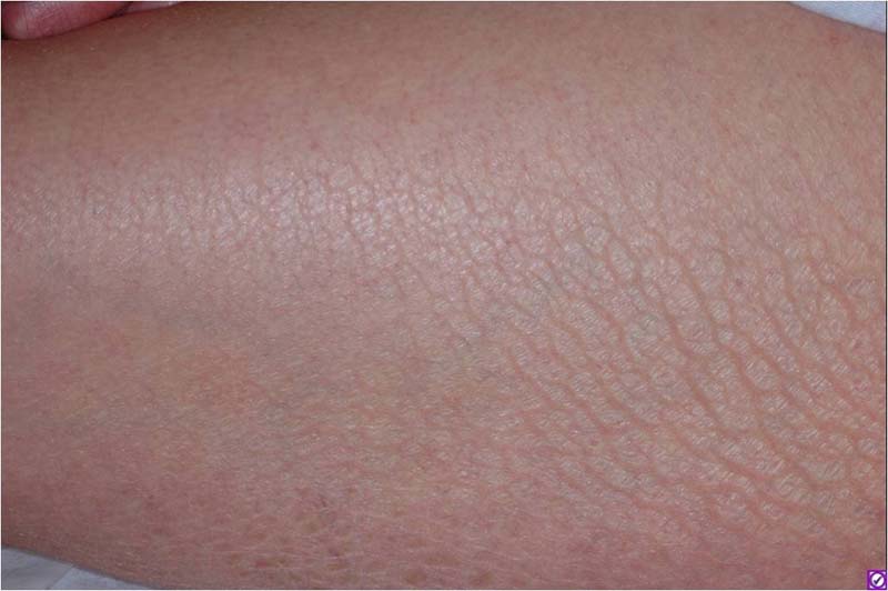 Asteatotic Dermatitis (Eczema Craquelé) The Clinical Advisor