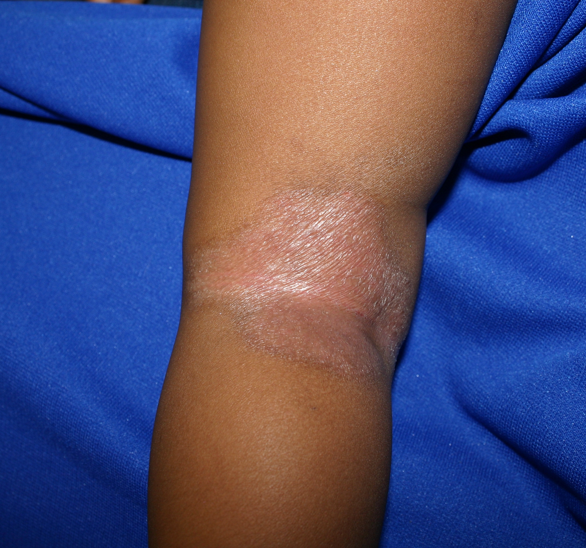 Risposte di shampoo di zinco di friderm a psoriasi