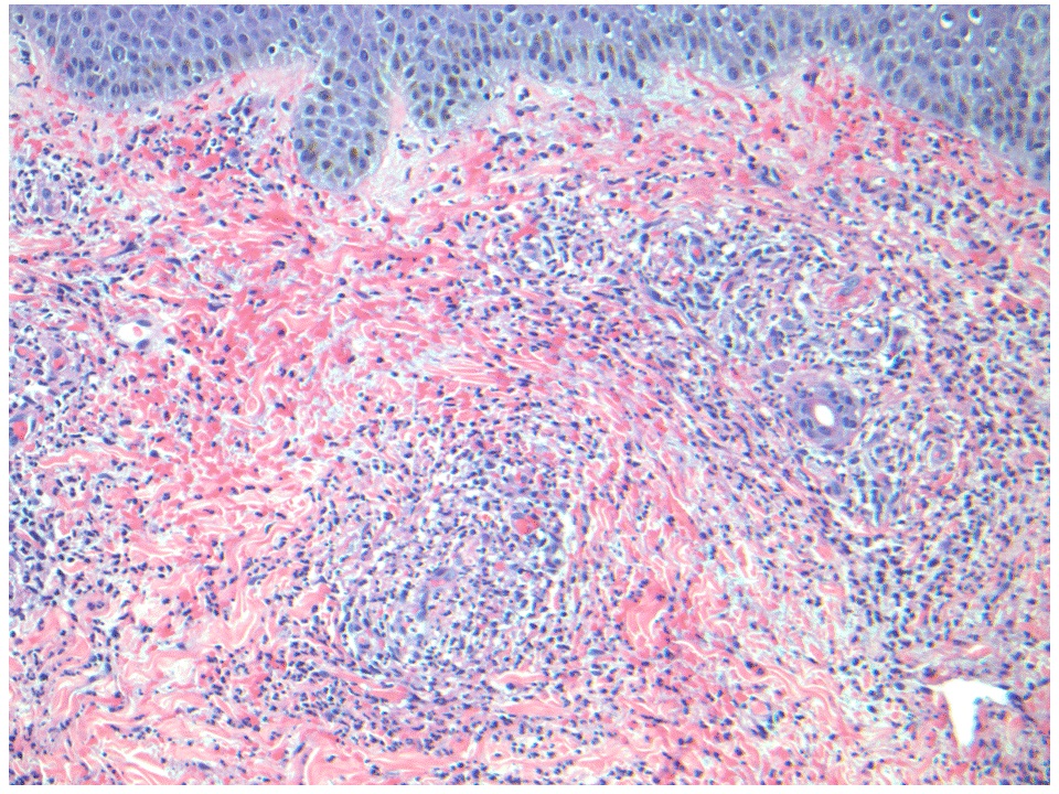 Leukocytoclastic vasculitis - The Clinical Advisor