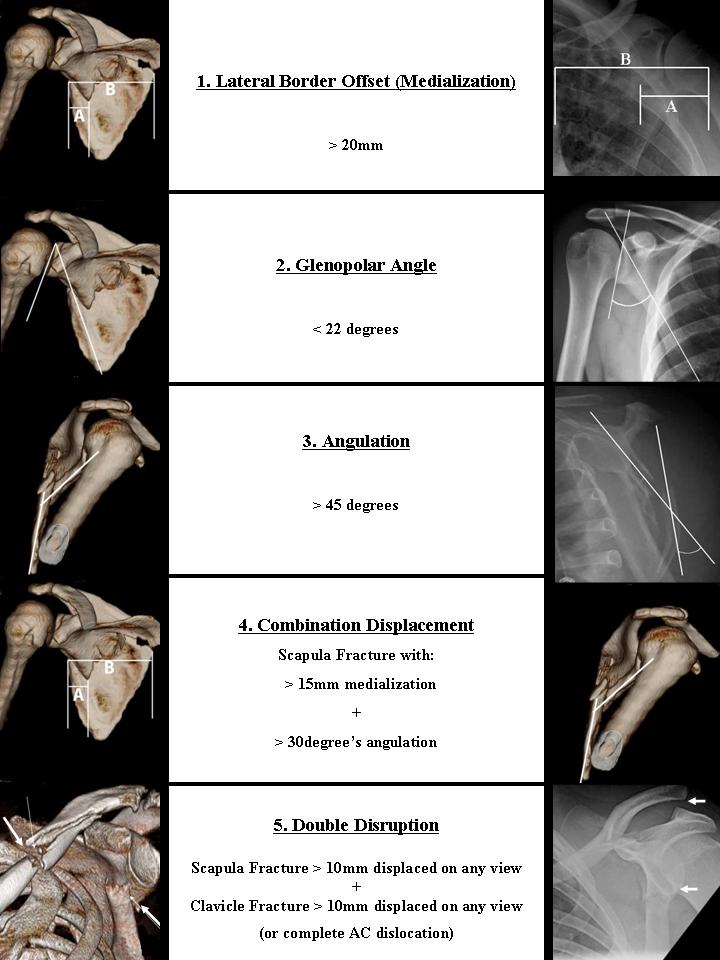 Treating Glenoid Fractures The Clinical Advisor