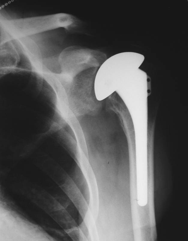 Chronic Glenohumeral Dislocation: Anterior And Posterior - The Clinical 