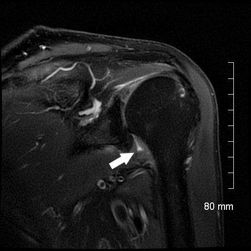 Adhesive Capsulitis Evaluation and Management The Clinical Advisor
