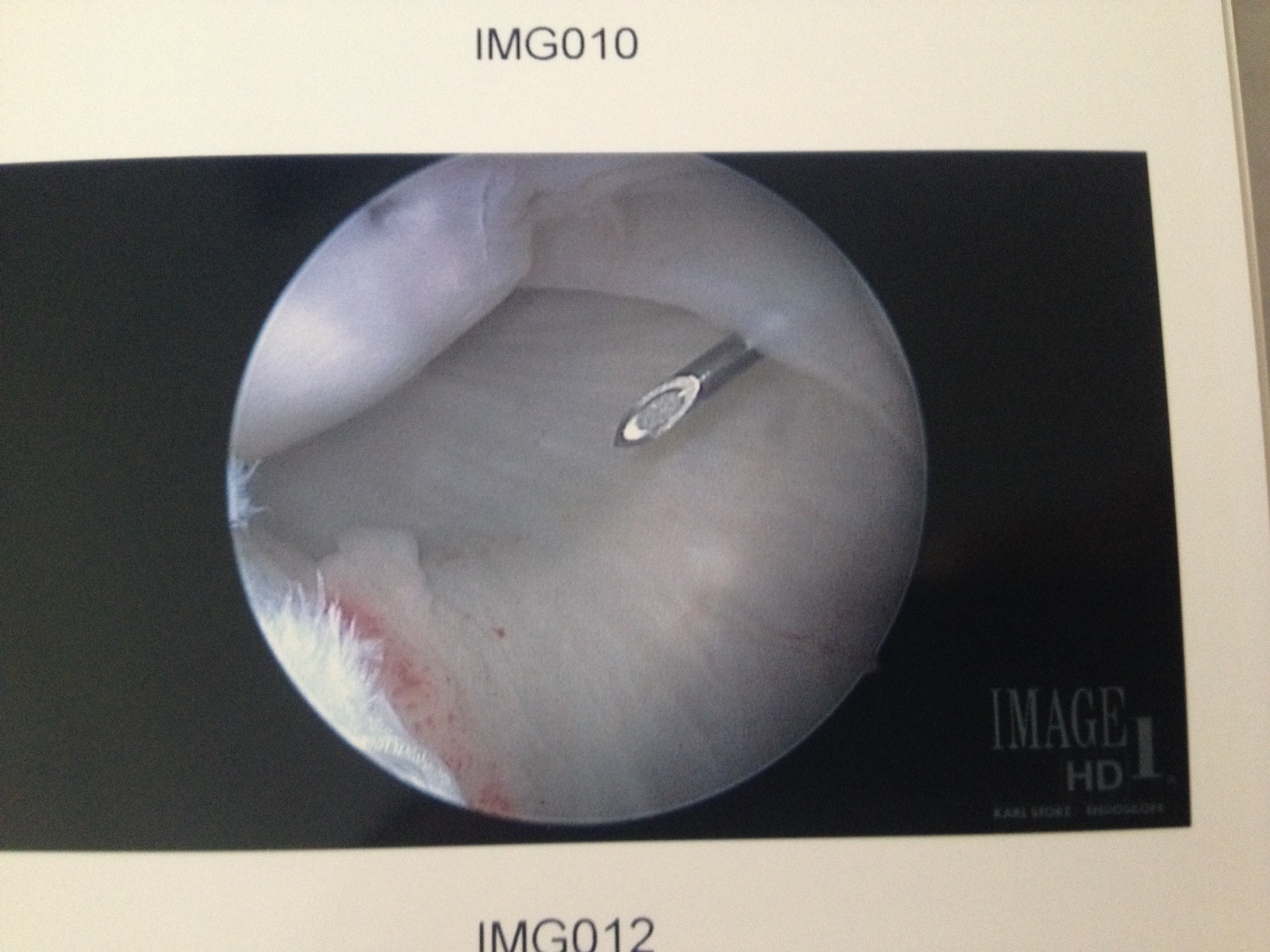 Treatment of Posterior Labral Tears The Clinical Advisor