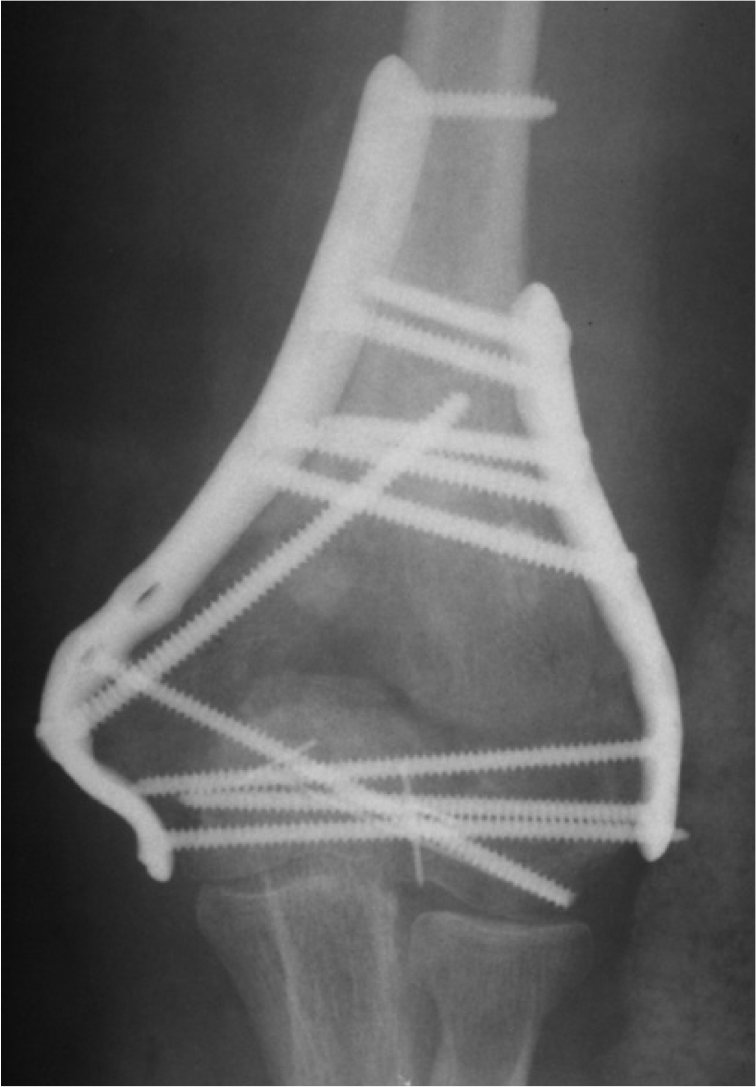 Treatment Of Distal Humerus Fractures The Clinical Advisor