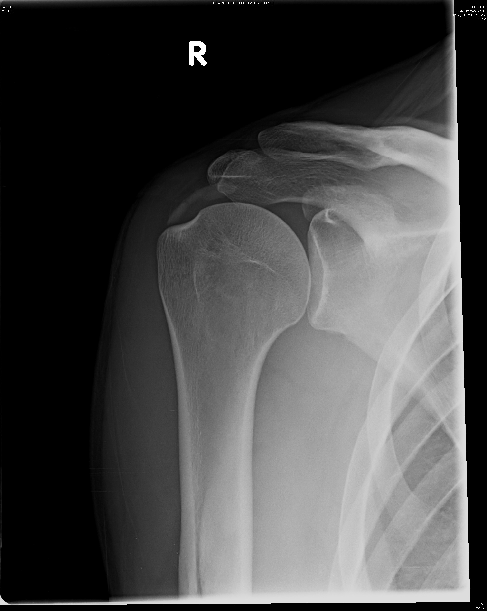 What Causes Calcification In Rotator Cuff At Troy Davis Blog