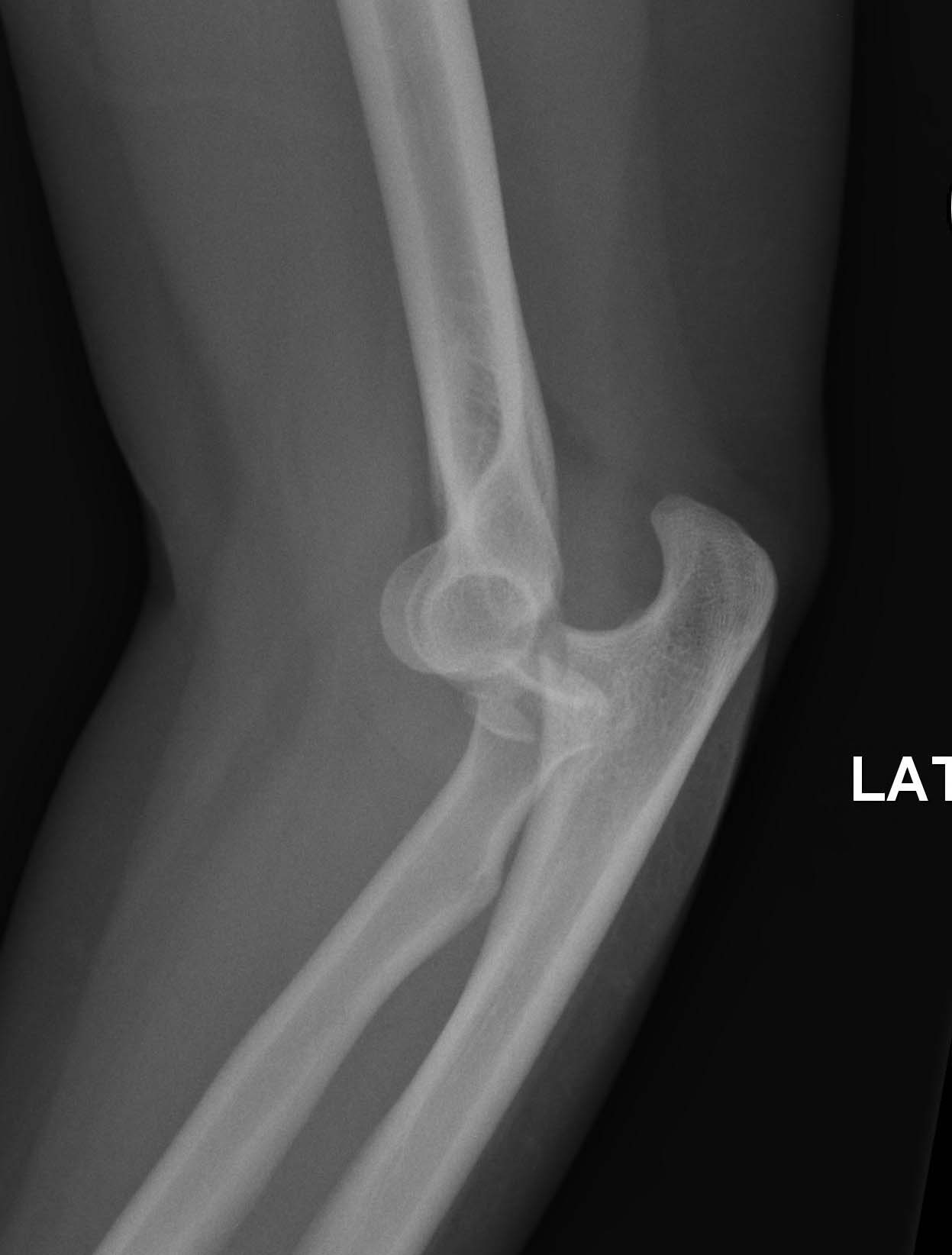 Evaluation And Management Of Complex Elbow Dislocations - The Clinical ...