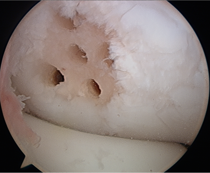 Elbow osteochondritis dissecans The Clinical Advisor