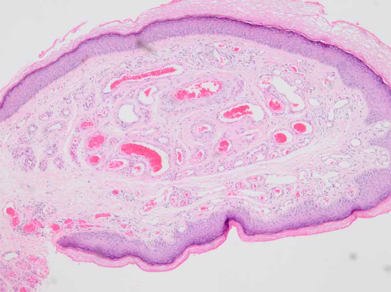 Cherry angioma (Cherry hemangioma, Senile Angioma, CampbellDe