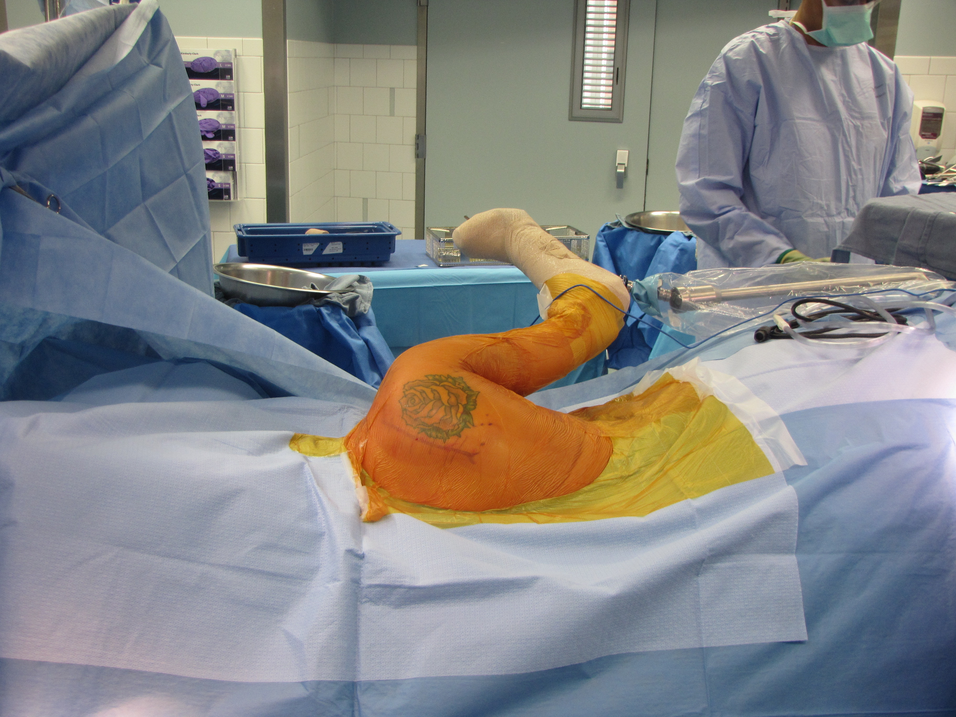 Evaluation and Management of Scapular Winging due to spinal accessory