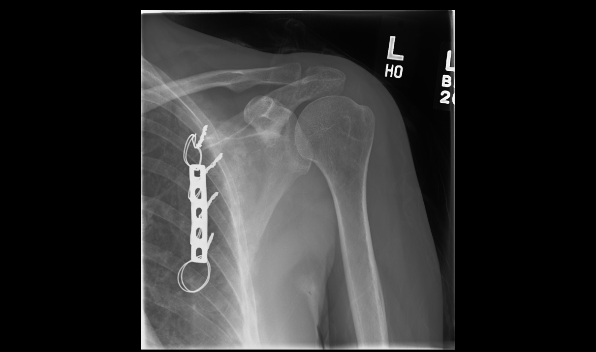 Evaluation and Management of Scapular Winging due to