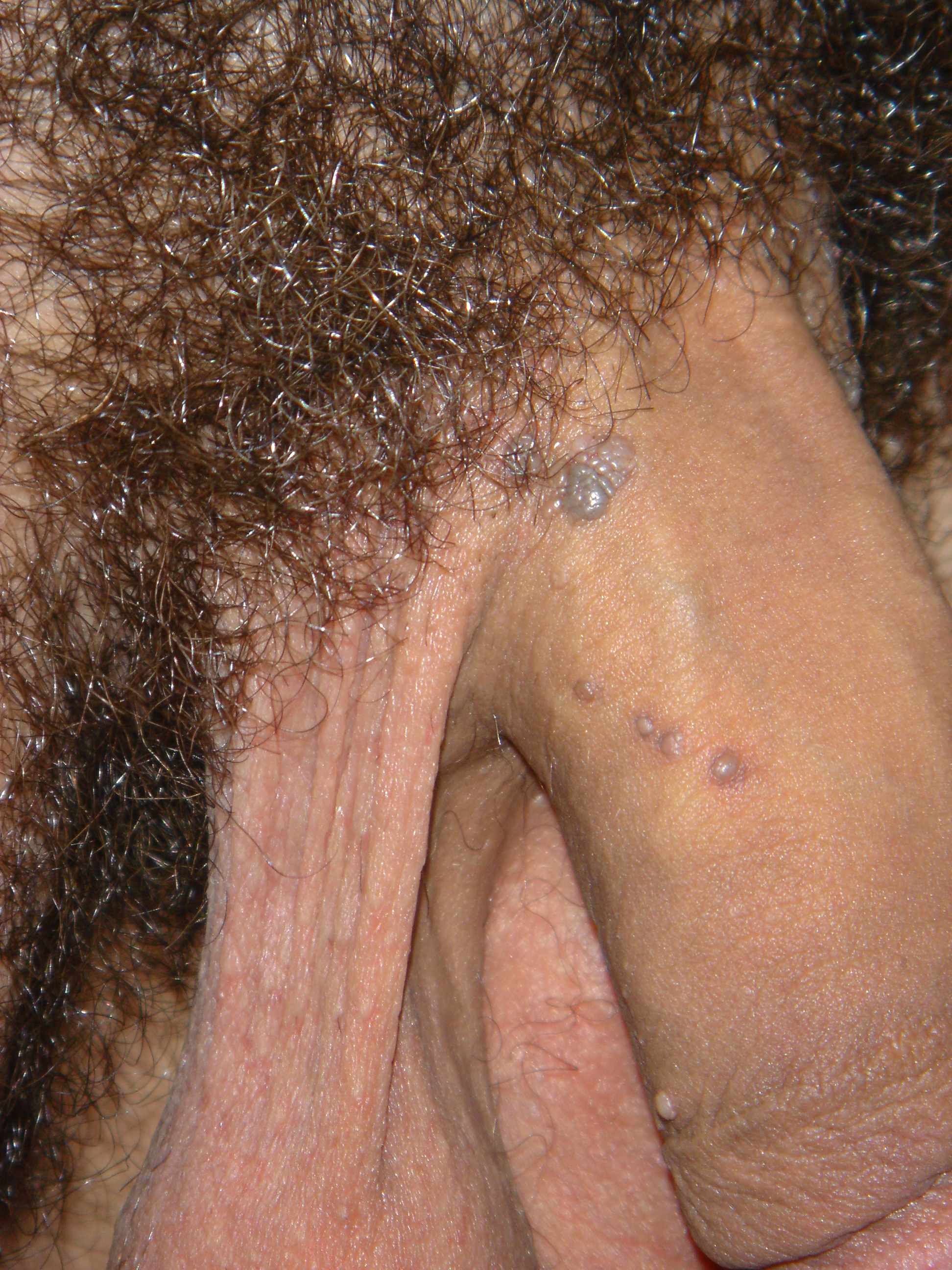 Cutaneous Penile Lesions - Genitourinary Disorders - Merck ...