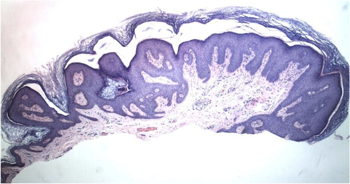 Condyloma Acuminatum Genital Warts The Clinical Advisor