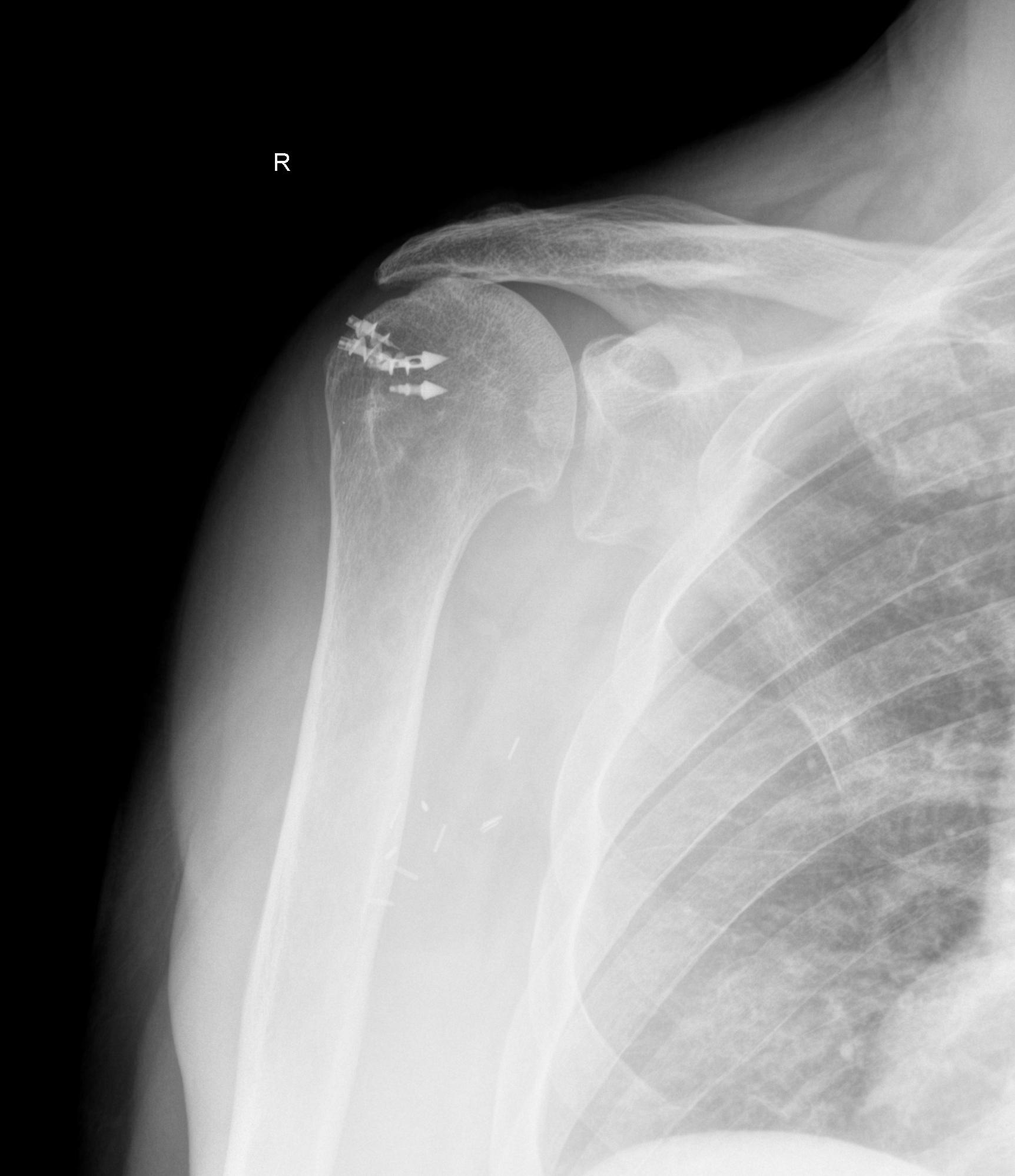 Managing the Failed Rotator Cuff Repair The Clinical Advisor