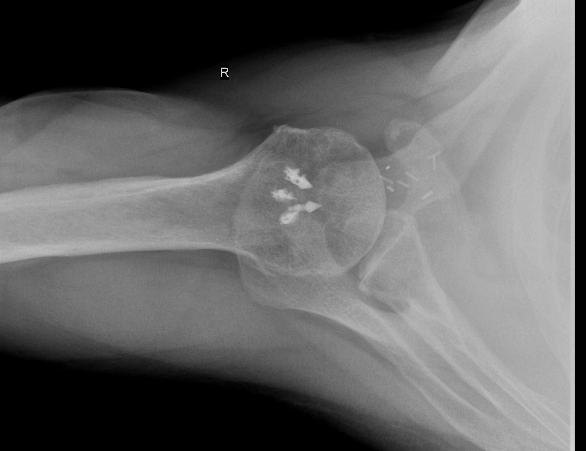 Managing the Failed Rotator Cuff Repair The Clinical Advisor