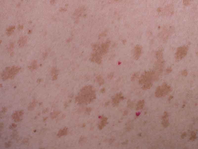 Ephelides (freckles) The Clinical Advisor