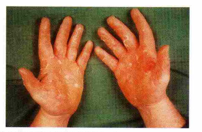 Erythrokeratolysis heimalis (keratolytic winter erythema, Oudtshoorn ...