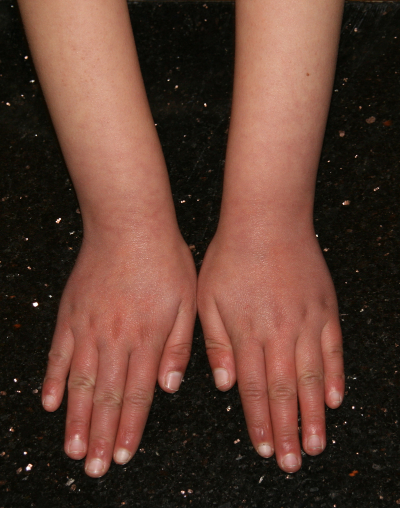 Erythromelalgia (Erythermalgia) The Clinical Advisor