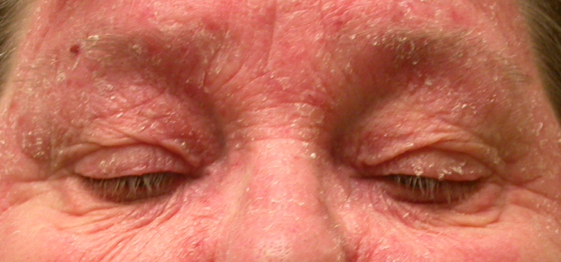 Eyelid Dermatitis Xeroderma Of The Eyelids Eczema Of The Eyelids 