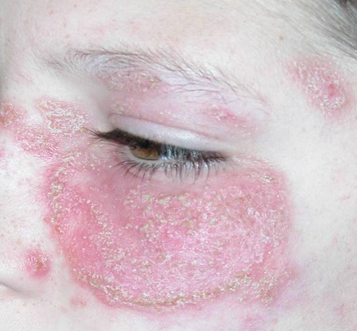 Eyelid Dermatitis (xeroderma of the eyelids, eczema of the eyelids