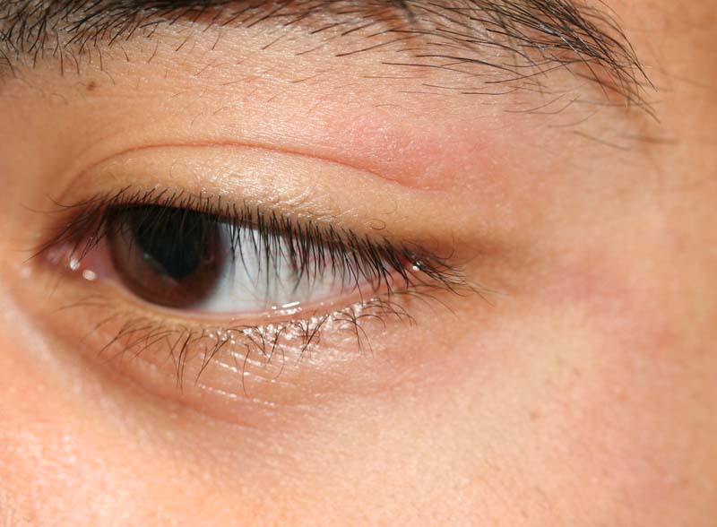 Eyelid Dermatitis (xeroderma of the eyelids, eczema of the eyelids