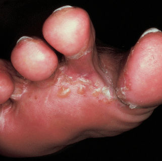 Inflammation and vesicles on a wrestler's feet - The Clinical Advisor