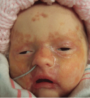 Scaly, atrophic rash on the face and back of a newborn 