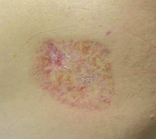 Erythema and bruising that turned painful and pruritic Erythema and bruising that turned painful and pruritic