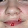 Clinical management of dog-bite injuries Clinical management of dog-bite injuries