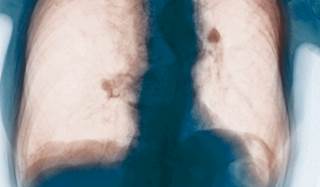 A larger role for PCPs in COPD management A larger role for PCPs in COPD management