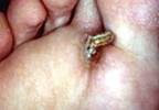 Rapidly enlarging conical lesion on the plantar surface Rapidly enlarging conical lesion on the plantar surface