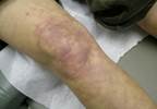 Annular purpuric rash on the lower extremities Annular purpuric rash on the lower extremities