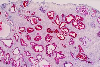 Dye binds to proteins altered by prostate cancer fo form PSA. Dye binds to proteins altered by prostate cancer fo form PSA.