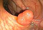 Colorectal cancer: Prevention vs. detection Colorectal cancer: Prevention vs. detection