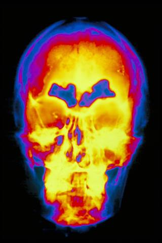 Sinusitis (blue) usually results from bacterial infection of the mucous membrane. Sinusitis (blue) usually results from bacterial infection of the mucous membrane.