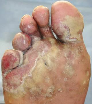 Pustules, maceration, and malodorous drainage of the foot Pustules, maceration, and malodorous drainage of the foot