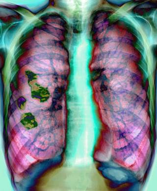 Hyperinflated lungs consistent with COPD caused by emphysema or bronchitis Hyperinflated lungs consistent with COPD caused by emphysema or bronchitis
