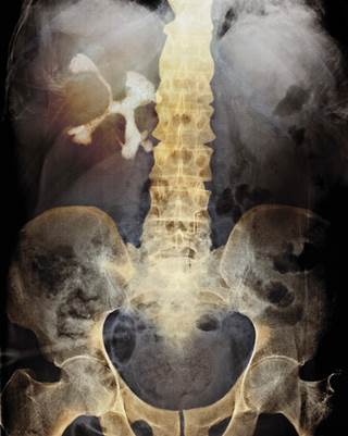 Kidney stones (white) may be caused by dehydration, infection, or metabolic disorders. Kidney stones (white) may be caused by dehydration, infection, or metabolic disorders.