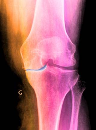 Osteoarthritis caused by erosion of the cartilage (blue) lining the knee Osteoarthritis caused by erosion of the cartilage (blue) lining the knee