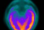 Epilepsy in the elderly Epilepsy in the elderly