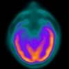 Epilepsy in the elderly Epilepsy in the elderly