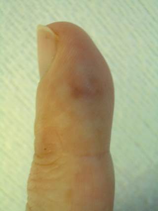 a tender finger papule fever and abdominal pain the clinical advisor